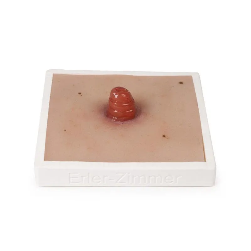 Wound Moulage Ileostoma, incl. Stand